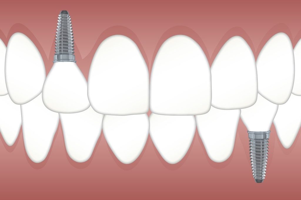 teeth, implant, orthodontics-3597679.jpg